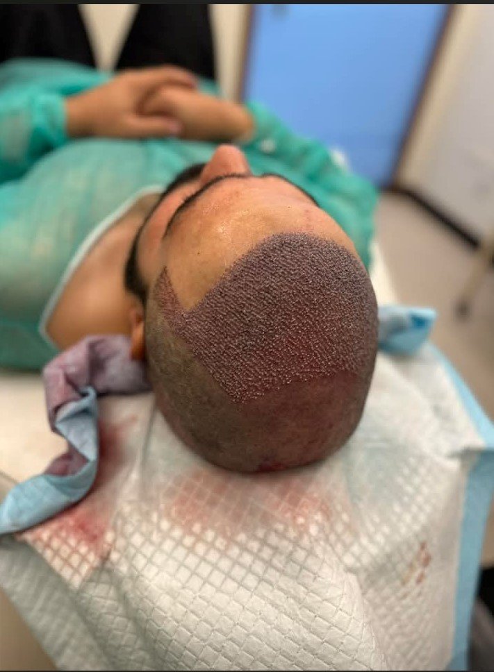 FUE Transplant