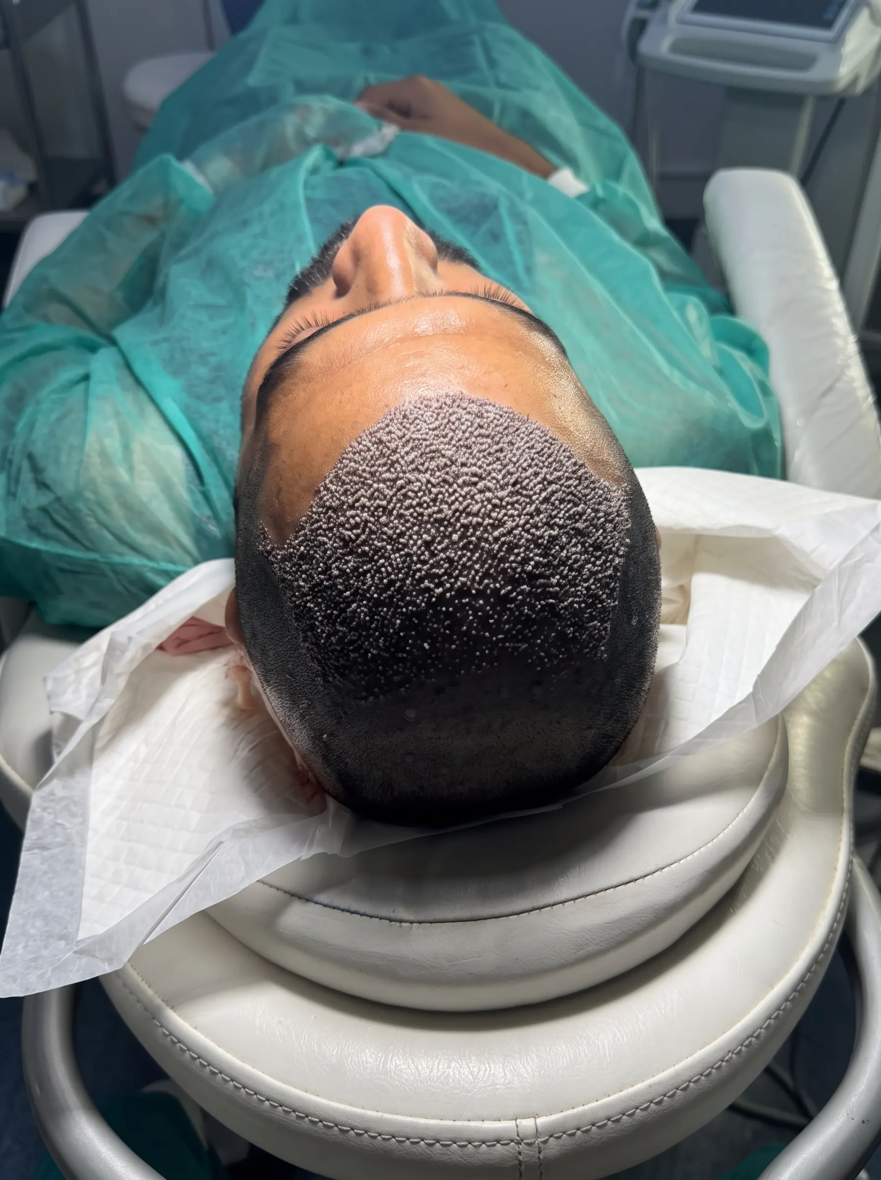 Hair Transplant